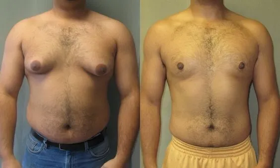 How To Get Rid Of Man Boobs