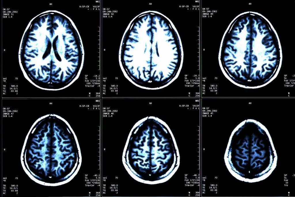 Risks And Safety Procedures For MRI Scanning