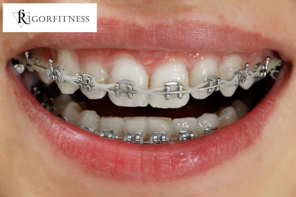 What do Your Braces Colors say About Your Personality