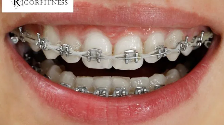 What do Your Braces Colors say About Your Personality