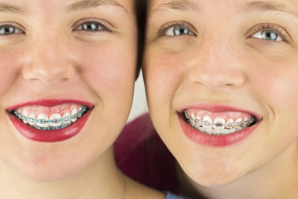 How Much are Braces