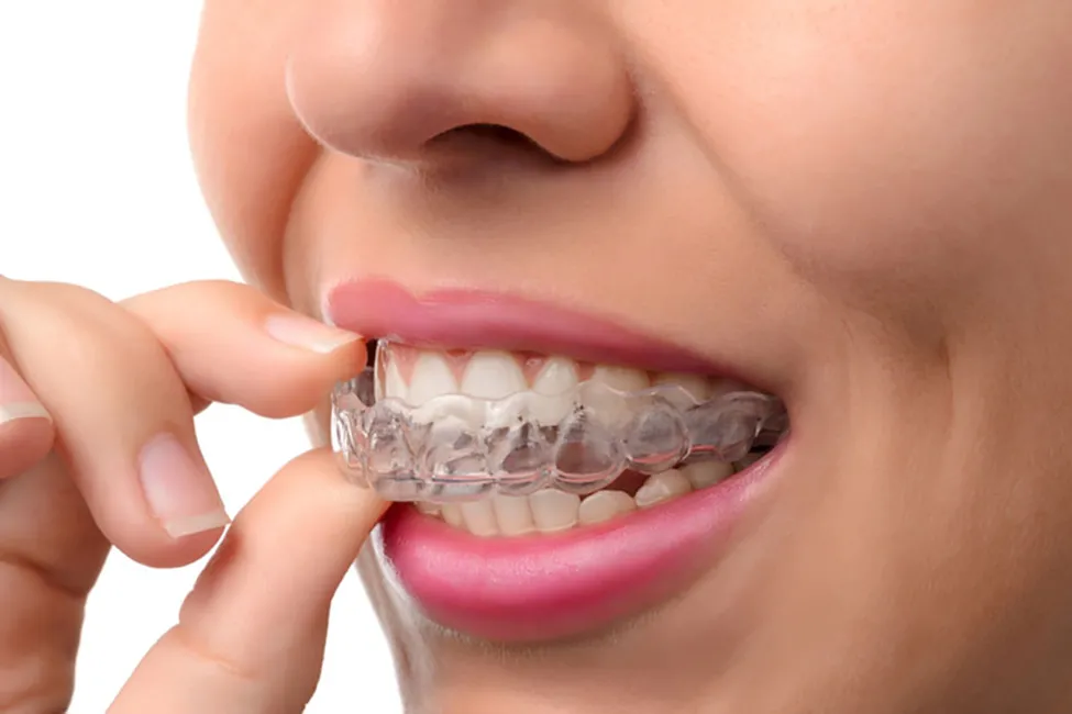 Invisible braces Vs Classic braces
