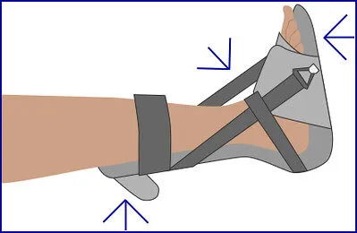 Ways to Look After a Splint